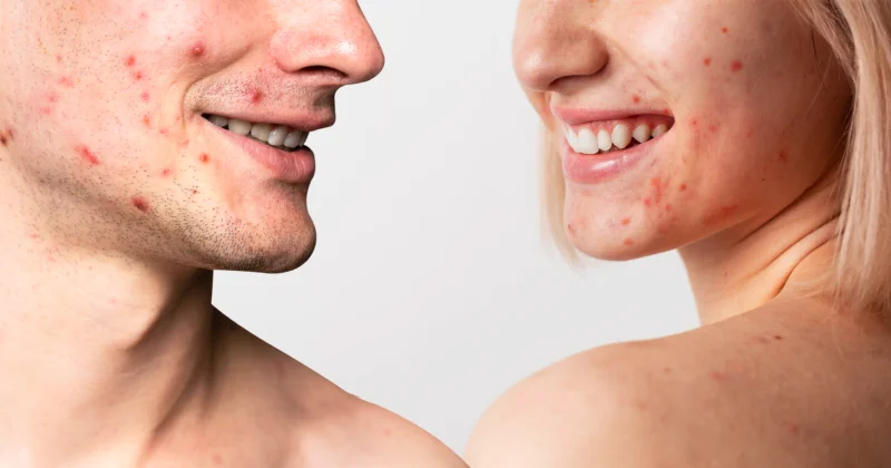 Acne: cause, sintomi e rimedi efficaci per una pelle sana