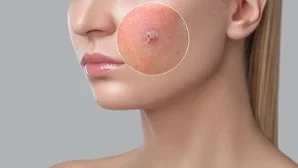 Approccio Clinico e Terapia Efficace per la Cheratosi Attinica: Uno Studio Osservazionale
