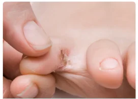 Disidrosi plantare: quadro clinico, eziopatogenesi e gestione terapeutica