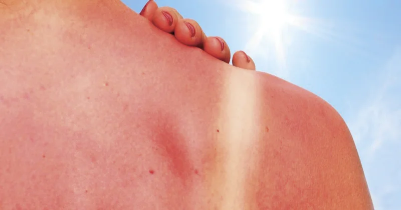 Vuoi un’abbronzatura sana? Impara a prevenire e trattare l’eritema solare