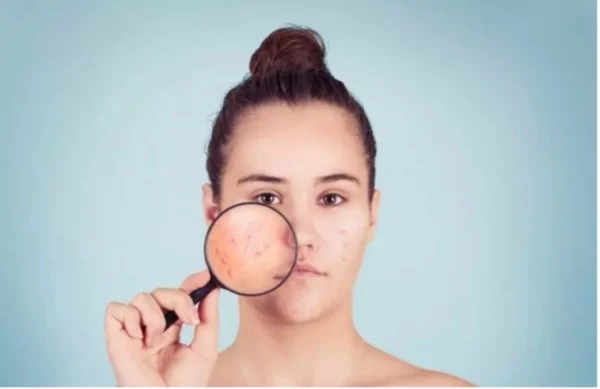 Acne da Sindrome dell’Ovaio Policistico: approccio terapeutico integrato